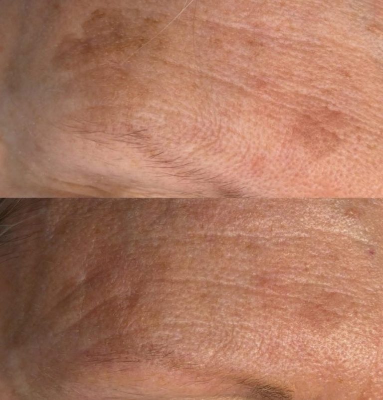 Before & after one treatment Before & after one treatment to target pigmentation